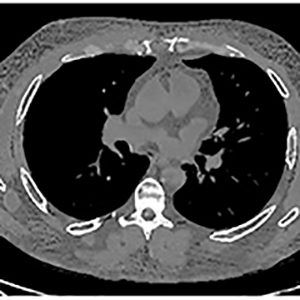 AI innovation may improve COVID-19 diagnosis